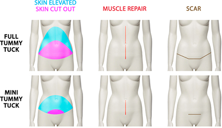 Mini-tummy-tuck-Cure-the-diastasis